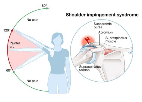 slap tear positive test|shoulder impingement vs slap tear.